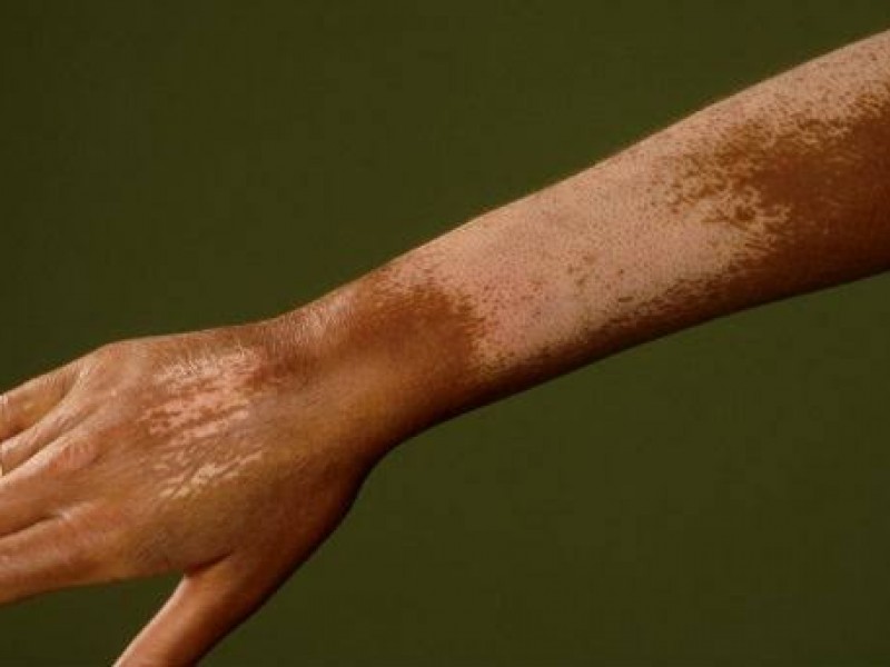 Vitíligo, enfermedad de piel que causa baja autoestima
