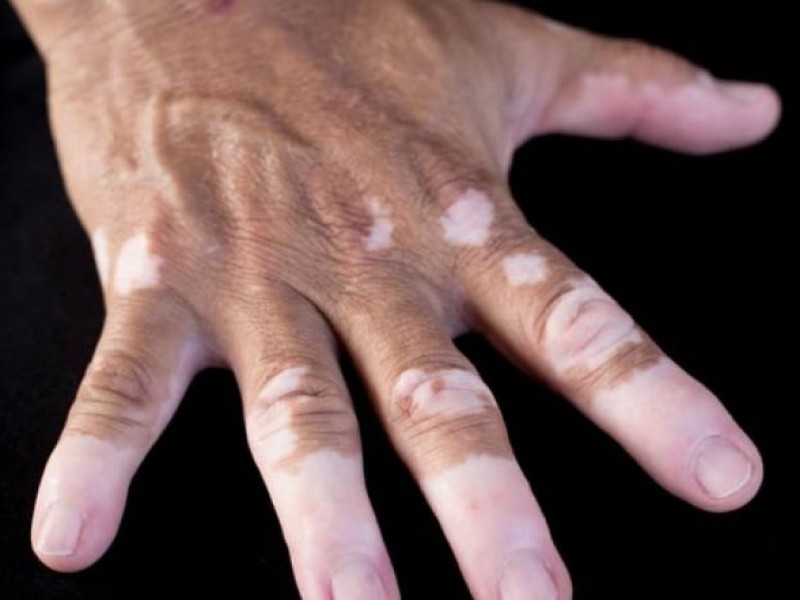 Vitiligo enfermedad hereditaria